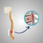 Spinal Tumor Surgery