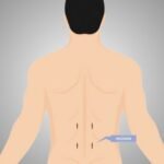 Endoscopic Spine Surgery