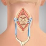 Cervical Spine Surgery